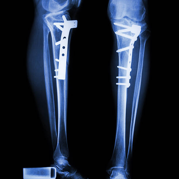 Trauma plates and screws